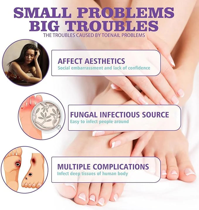 Jaysuin - Nail Fungus Spray (Original) 99 AED Only