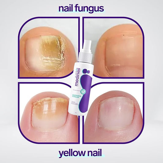 Jaysuin - Nail Fungus Spray (Original) 99 AED Only